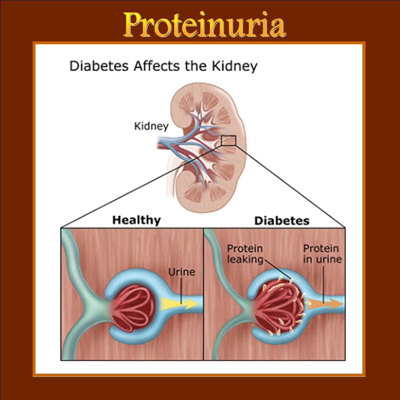 Proteinuria (High Protein In Urine)